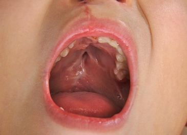 Осложнения при расщелине губы и неба у детей
